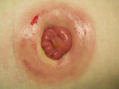 Stoma Bleeding and Irritation 